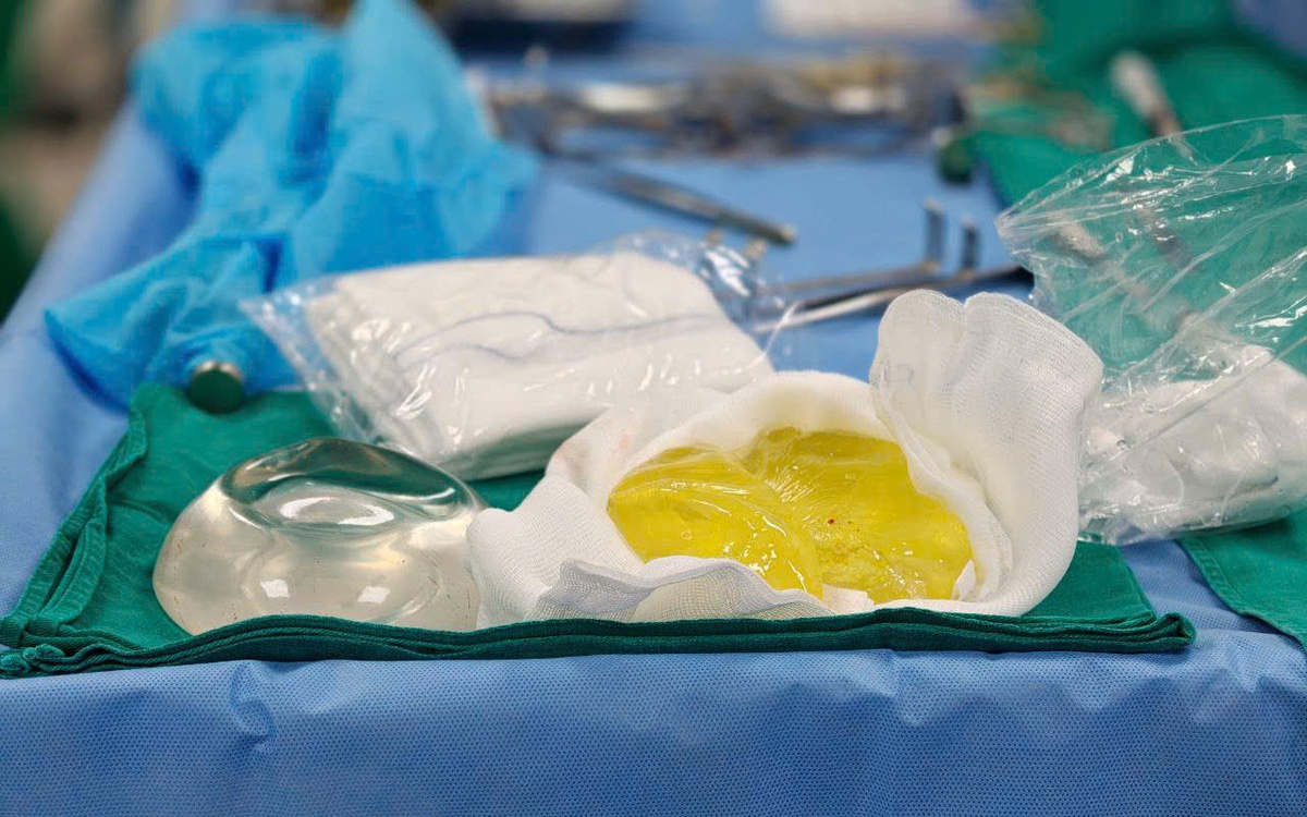 Discovery of Ruptured Breast Implant After 5 Years: Doctors Warn of Easily Overlooked Complications