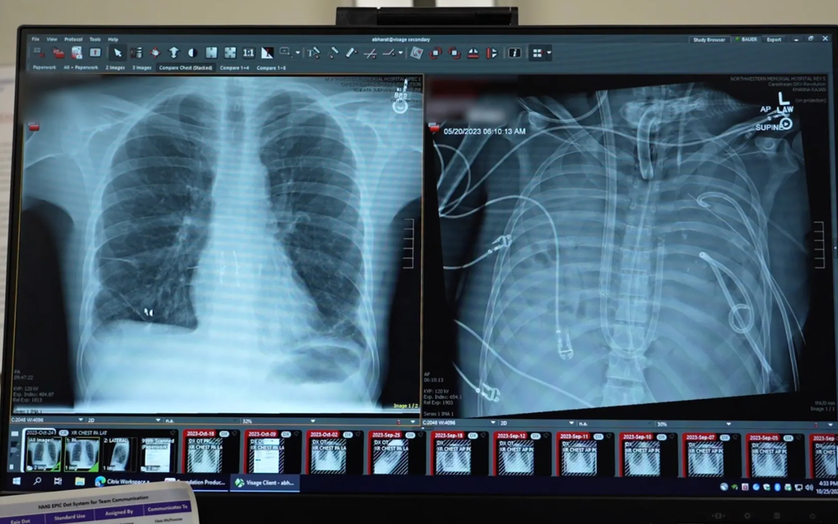 Medical Miracle: Surviving 48 Hours Without Lungs