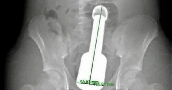 Metal Rod Lodged in Rectum: Adolescence and the Mindset of 'Let’s See What Happens'
