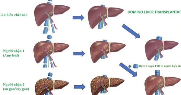 Vietnam Successfully Performs First Domino Multi-Organ Transplant